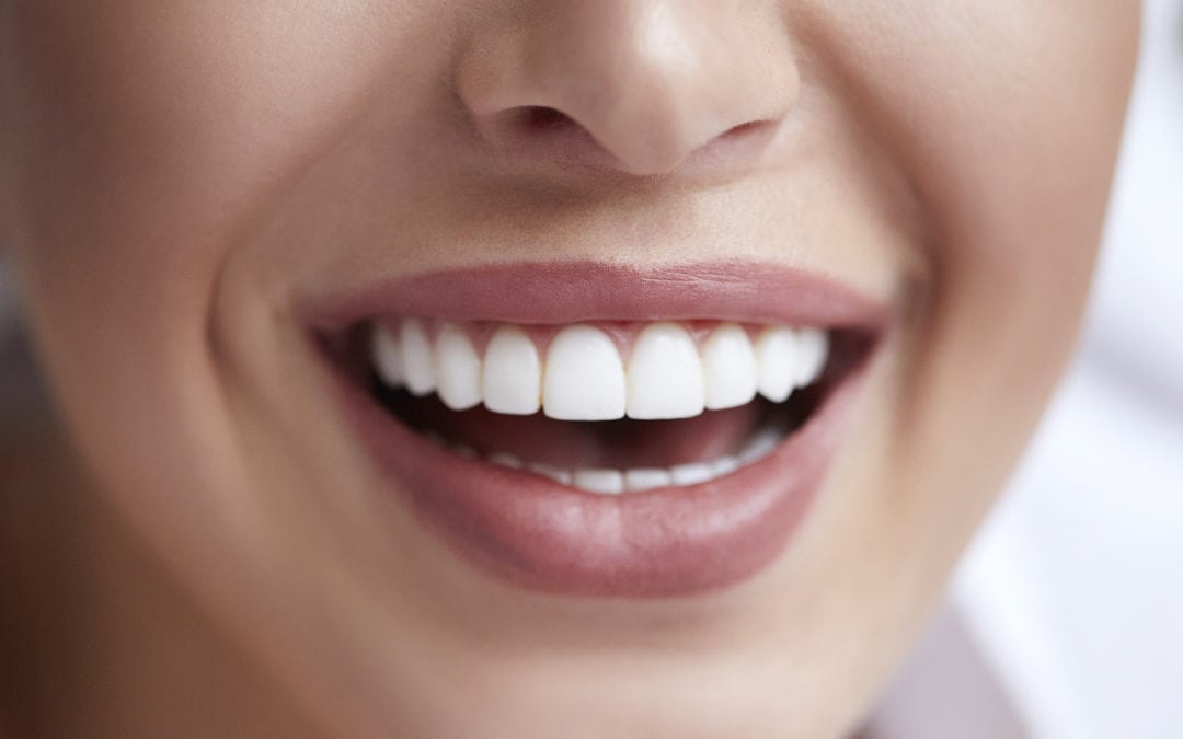 Dental Bonding: A Cost-Efficient Way To A Better Smile
